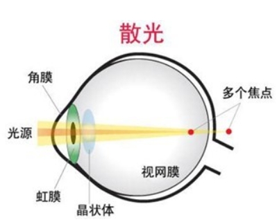 散光--不能忽视的屈光不正